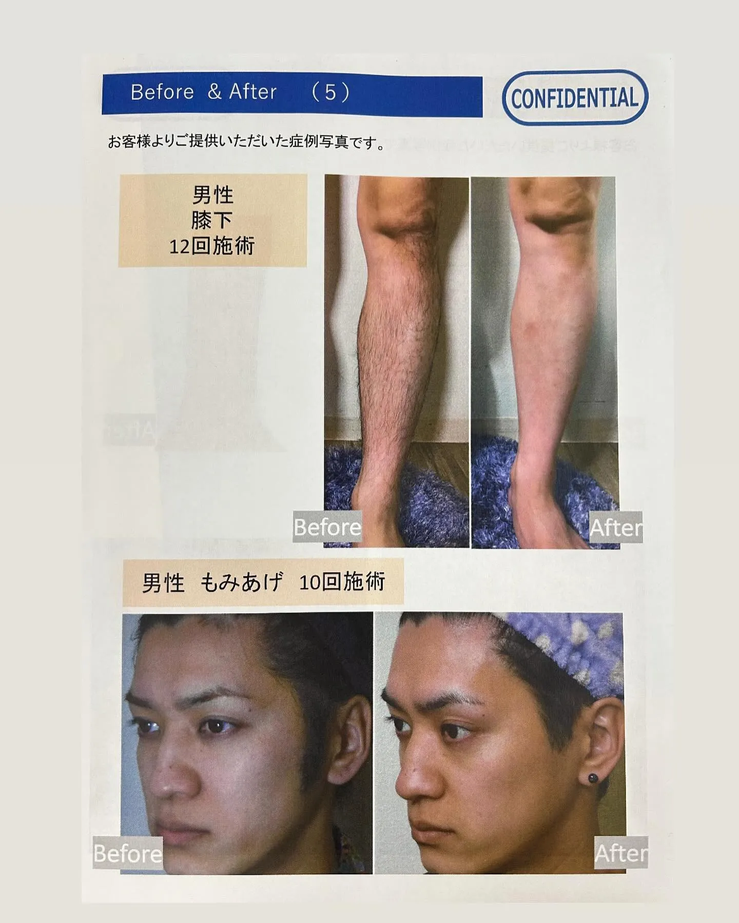 メンズ脱毛before after👨🏻甲賀市で脱毛はAnel...