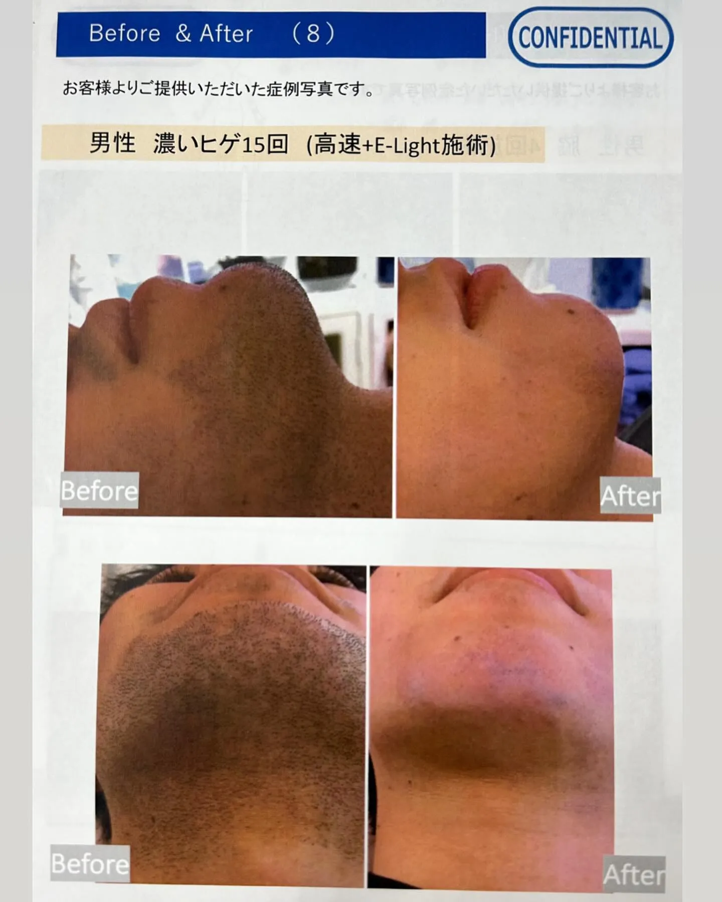 甲賀市のエステサロンAnela脱毛before&after👨...