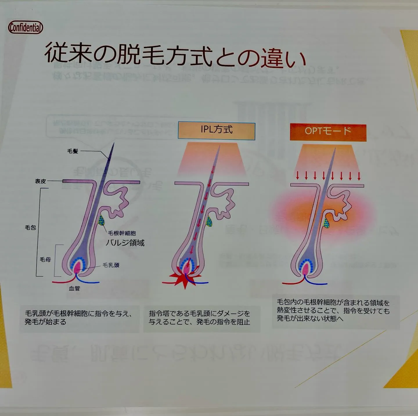 ANERAの脱毛器の紹介✨